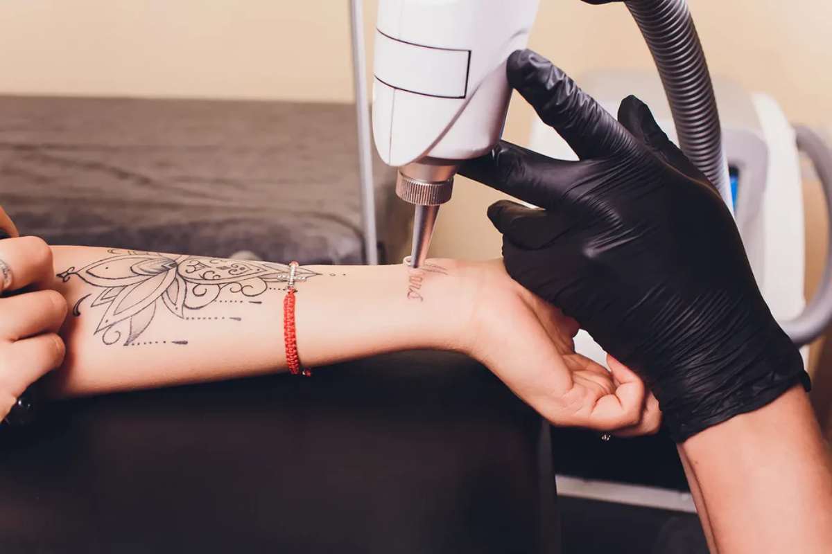 The Ultimate Guide to Tattoo Removal Tech and Methods